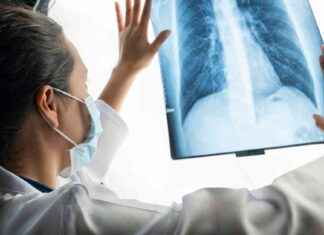 Krebsmetastasen: Symptome und Diagnose bei fortgeschrittener Krebserkrankung news-06082024-202031